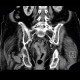 Colorectal cancer, tumorous stenosis of sigmoid colon, placement of stent: CT - Computed tomography